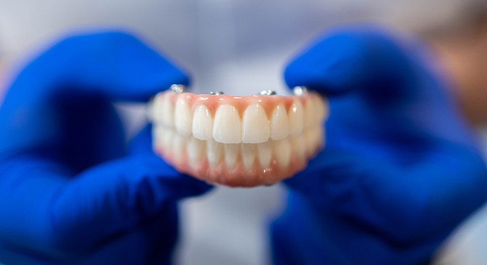 Full-arch implant-supported prosthesis